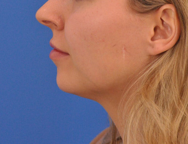 Chin Filler Before & After Gallery - Patient 399856 - Image 19