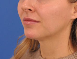 Chin Filler Before & After Gallery - Patient 399856 - Image 16