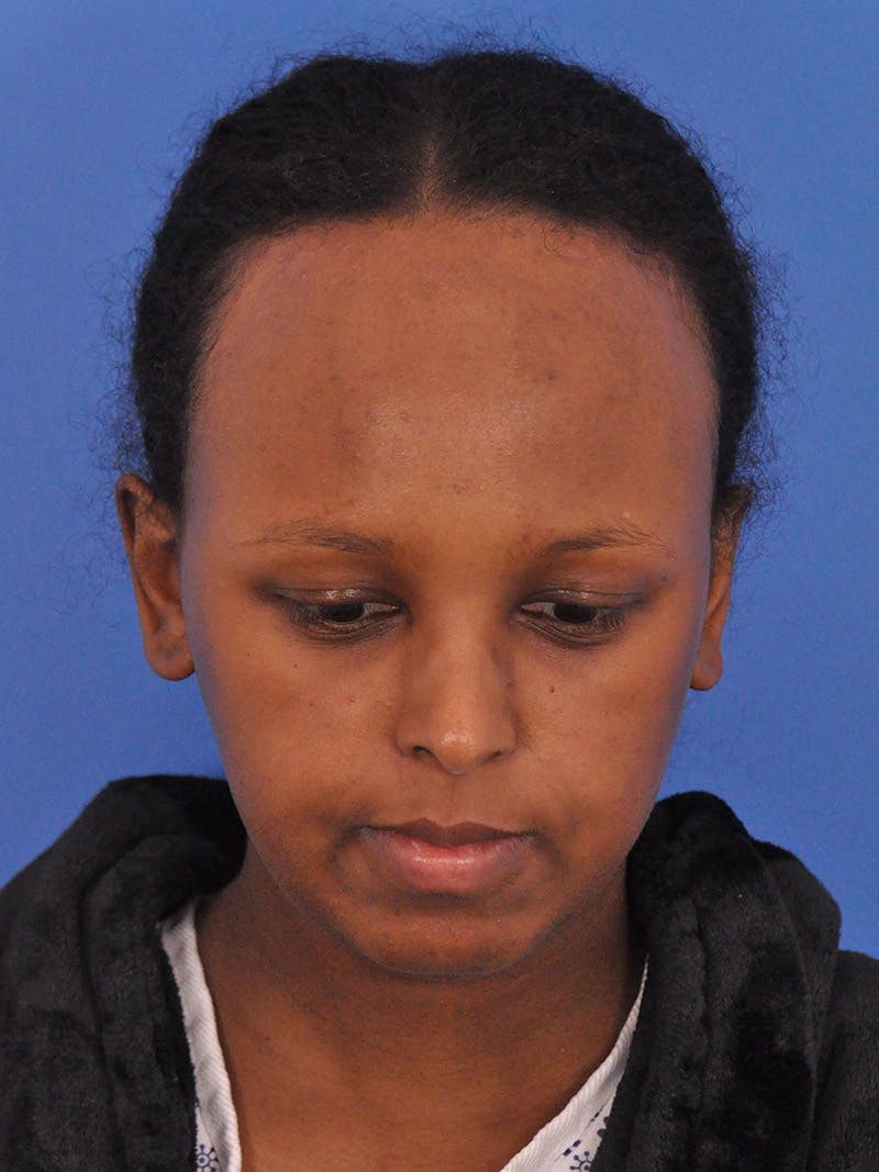 Forehead Reduction Before & After Gallery - Patient 196323 - Image 3