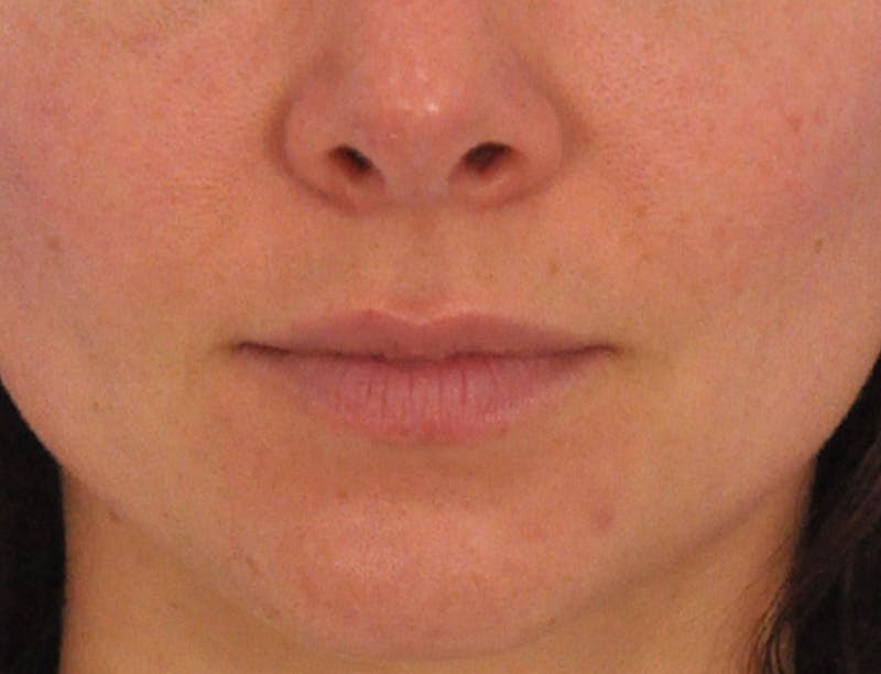 Lip Filler Before & After Gallery - Patient 829353 - Image 3