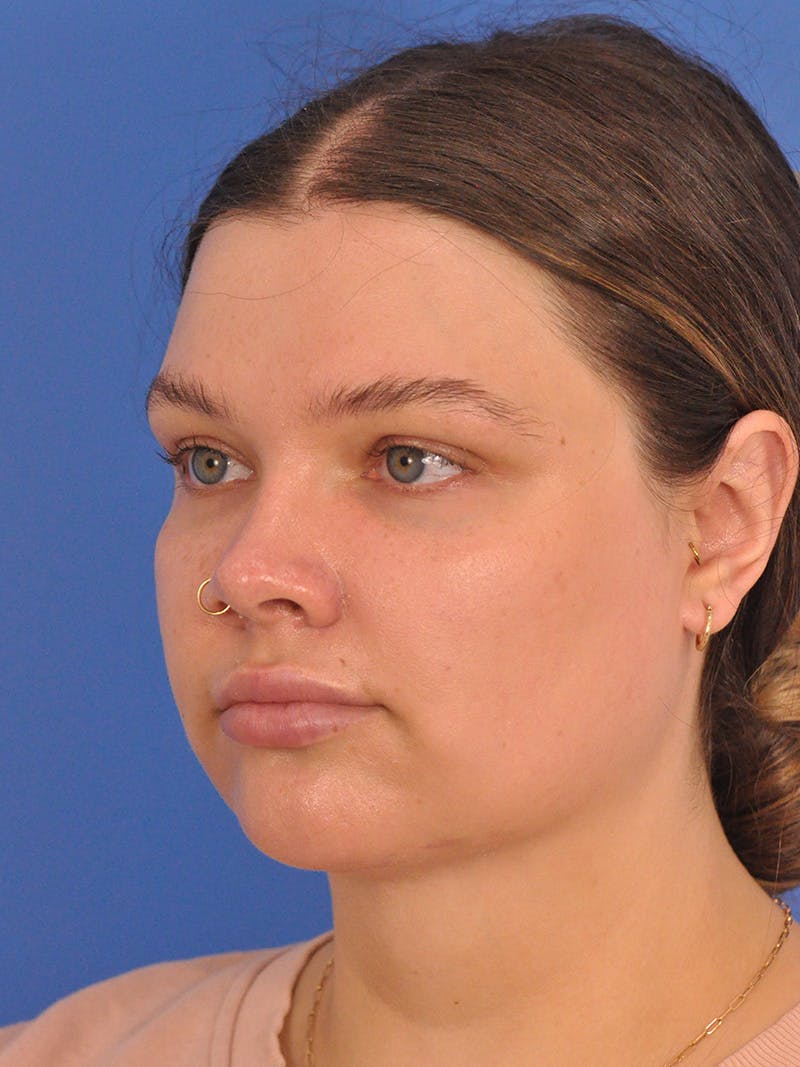 Chin Augmentation Before & After Gallery - Patient 174515 - Image 8