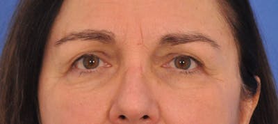 Blepharoplasty Before & After Gallery - Patient 761684 - Image 1