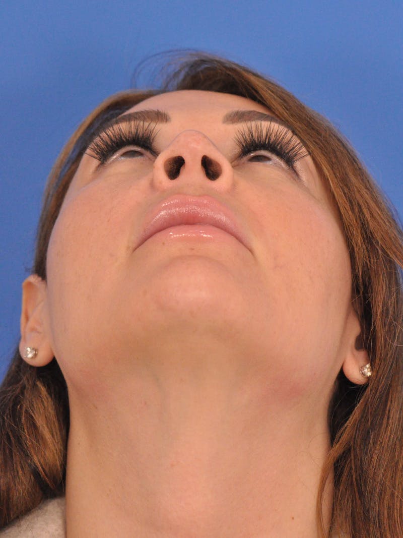 Rhinoplasty Before & After Gallery - Patient 386262 - Image 7