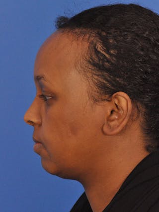 Forehead Reduction Before & After Gallery - Patient 196323 - Image 12