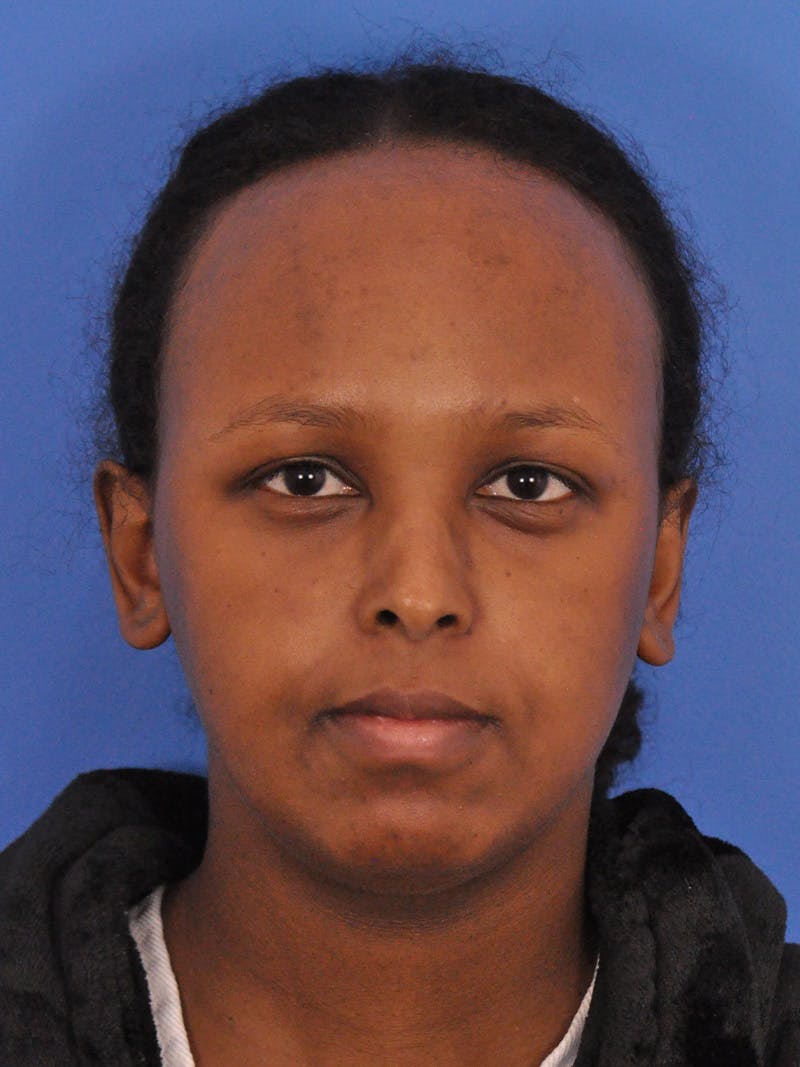 Forehead Reduction Before & After Gallery - Patient 196323 - Image 1