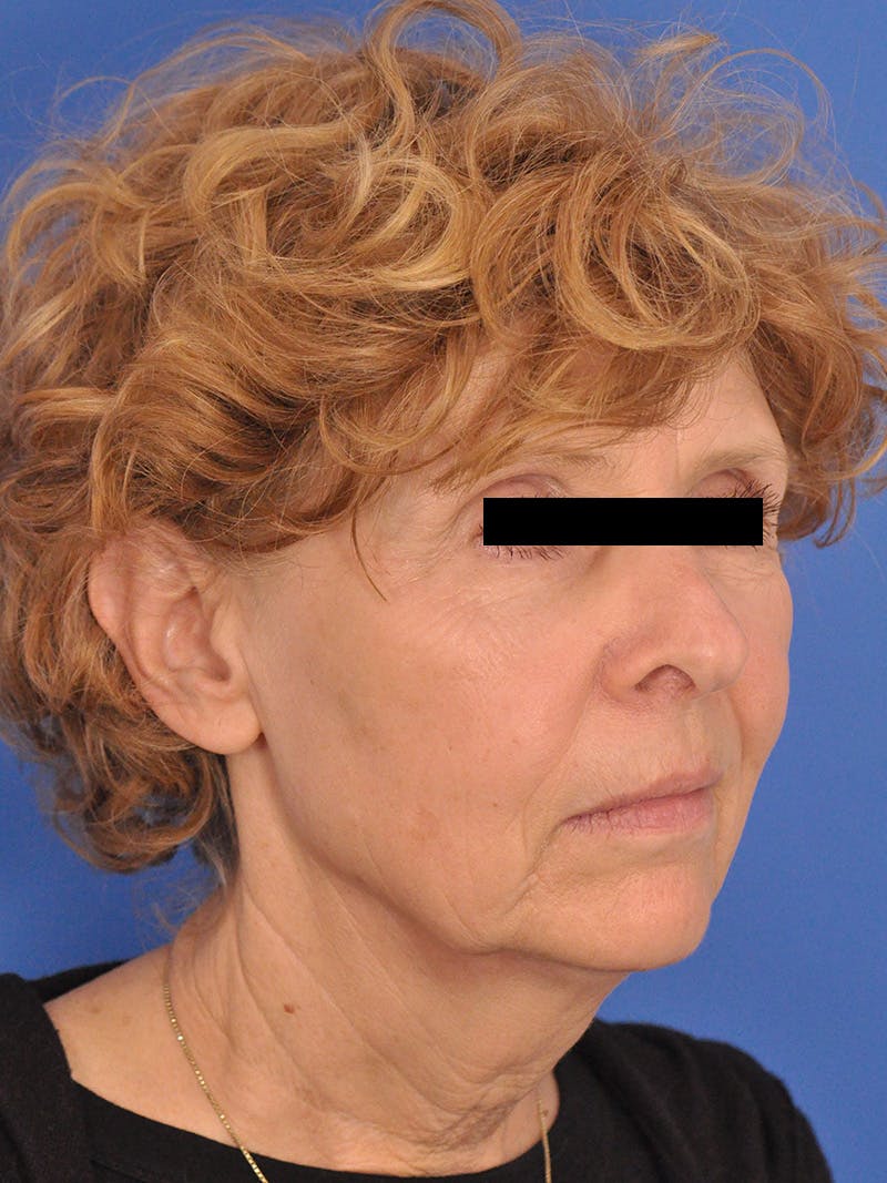 Neck Lift Before & After Gallery - Patient 220229 - Image 3