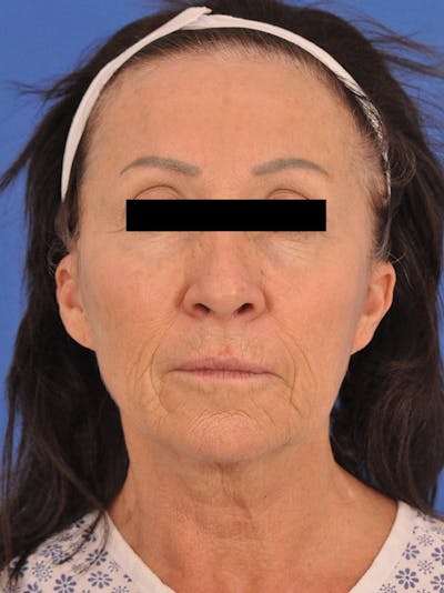 Facelift Before & After Gallery - Patient 210156 - Image 1
