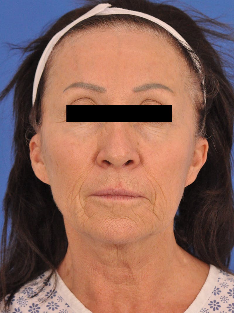 Neck Lift Before & After Gallery - Patient 128768 - Image 5