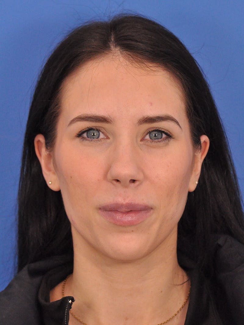 Rhinoplasty Before & After Gallery - Patient 405044 - Image 6