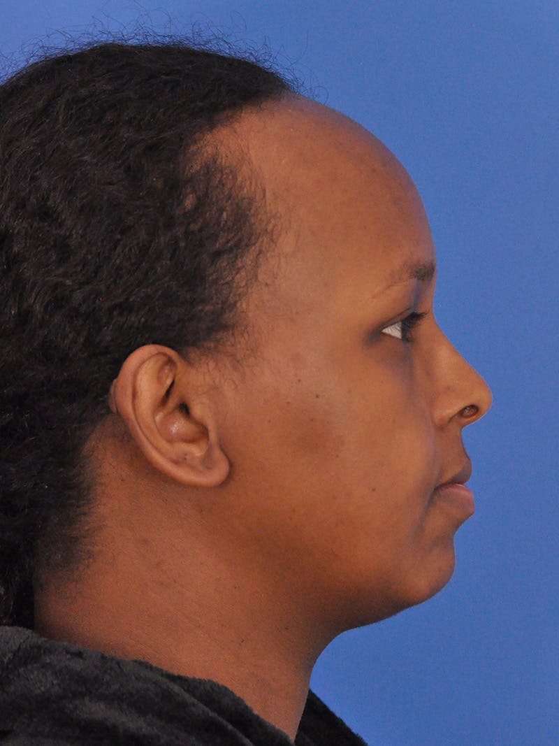 Forehead Reduction Before & After Gallery - Patient 196323 - Image 7