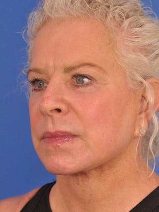 Neck Lift Before & After Gallery - Patient 563465 - Image 8