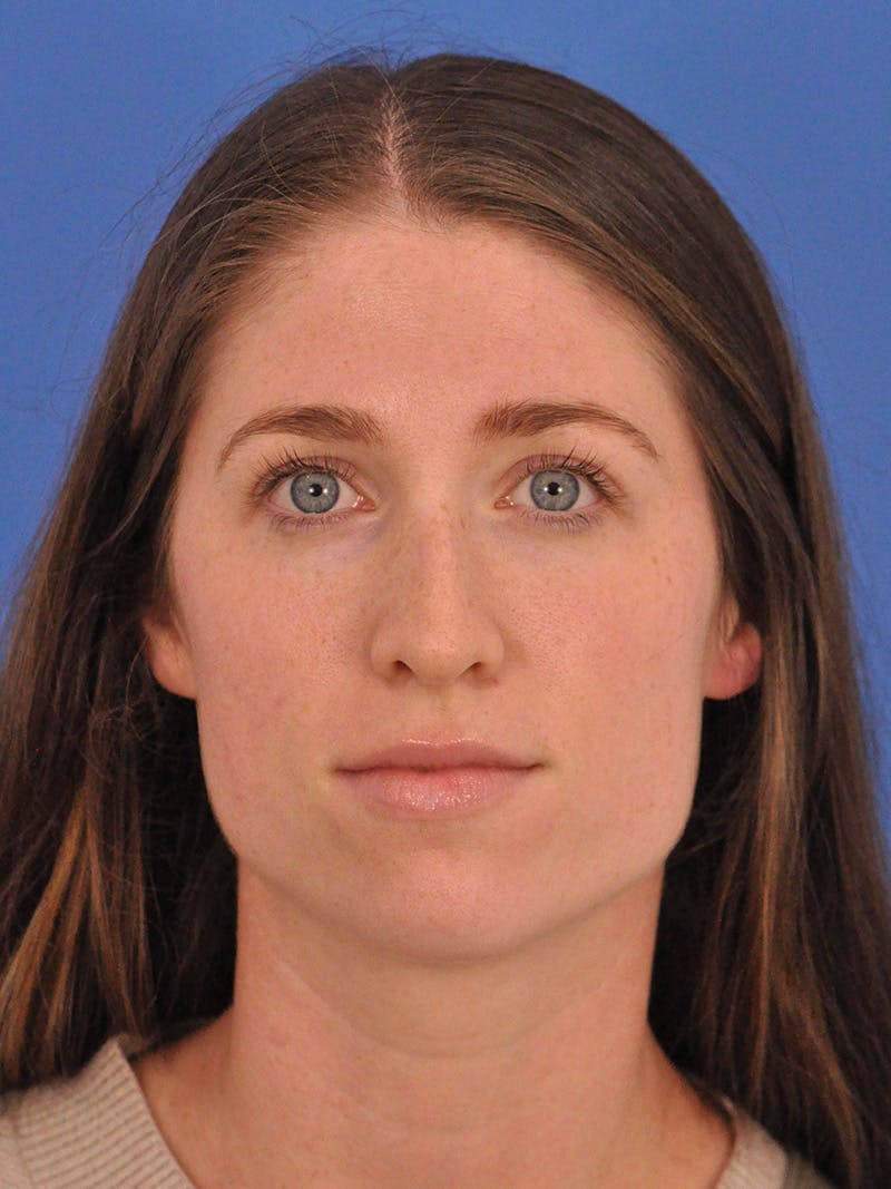 Liquid Rhinoplasty Before & After Gallery - Patient 395172 - Image 5
