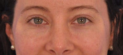 Tear Trough Filler Before & After Gallery - Patient 265185 - Image 1