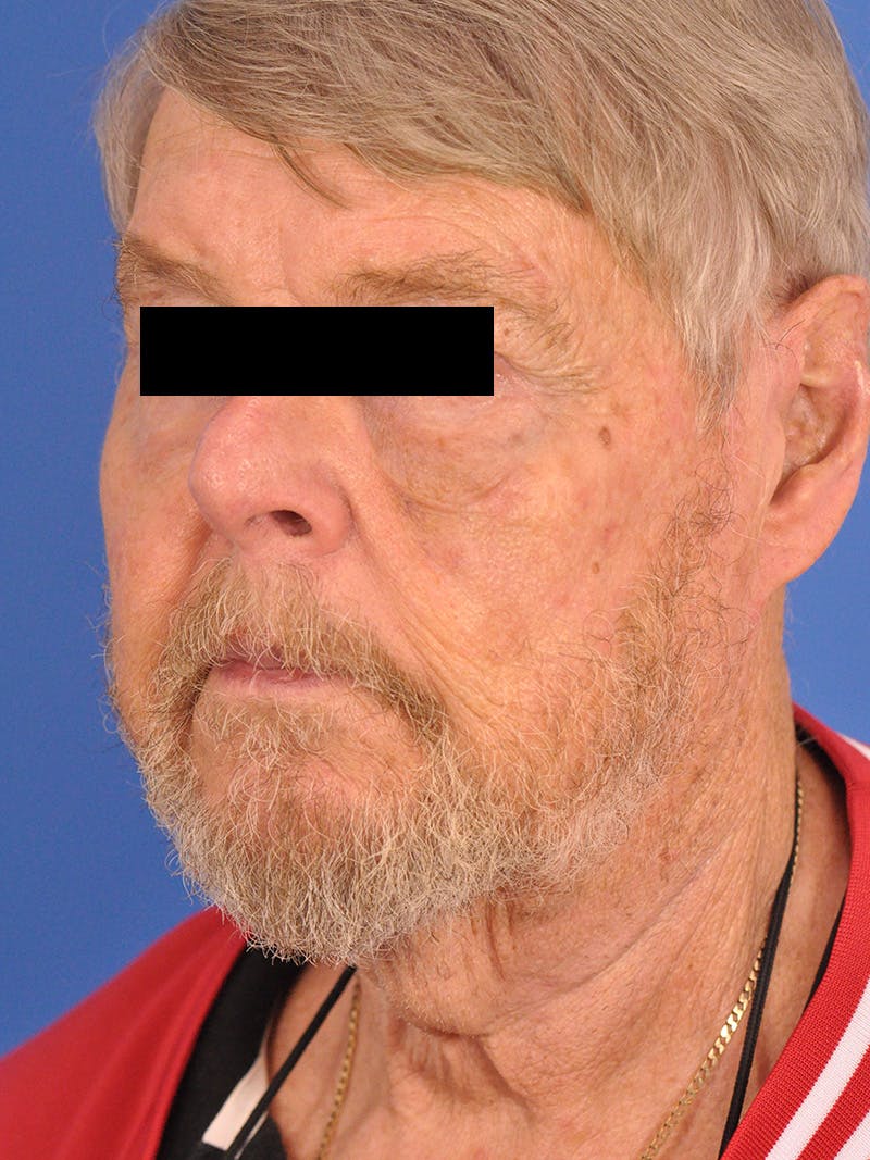 Neck Lift Before & After Gallery - Patient 891184 - Image 7