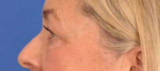 CO2RE Laser Before & After Gallery - Patient 140276 - Image 12