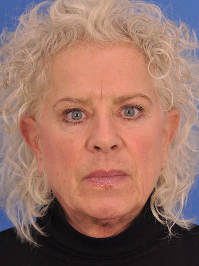 Facelift Before & After Gallery - Patient 485262 - Image 1