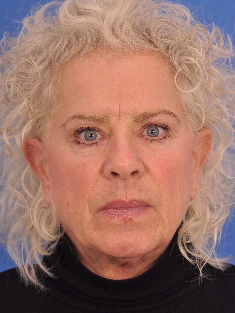 Neck Lift Before & After Gallery - Patient 563465 - Image 5