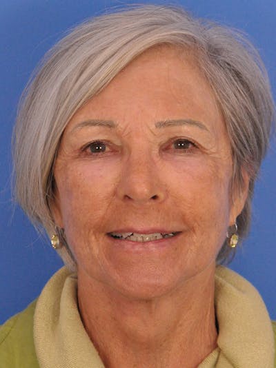 Facelift Before & After Gallery - Patient 436265 - Image 2