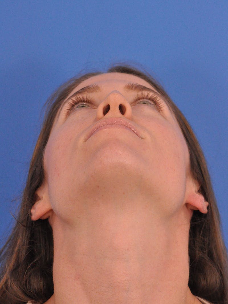 Liquid Rhinoplasty Before & After Gallery - Patient 395172 - Image 7