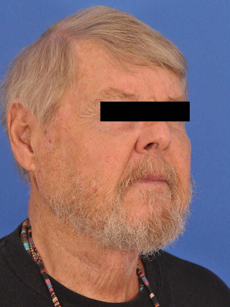 Neck Lift Before & After Gallery - Patient 891184 - Image 4