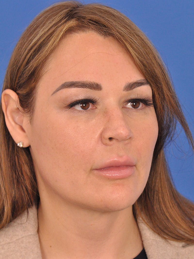 Rhinoplasty Before & After Gallery - Patient 386262 - Image 3