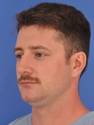 Chin Filler Before & After Gallery - Patient 228531 - Image 8