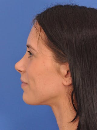 Rhinoplasty Before & After Gallery - Patient 405044 - Image 10