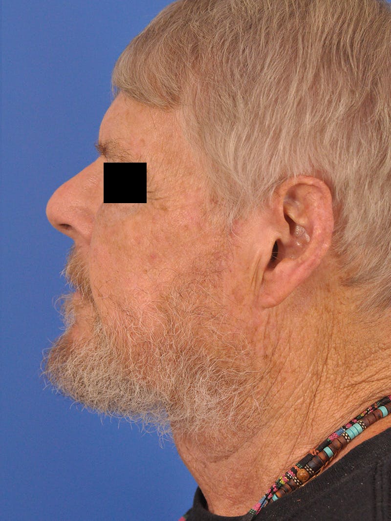 Neck Lift Before & After Gallery - Patient 891184 - Image 10