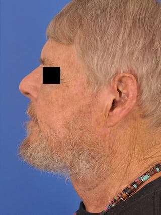Neck Lift Before & After Gallery - Patient 891184 - Image 10