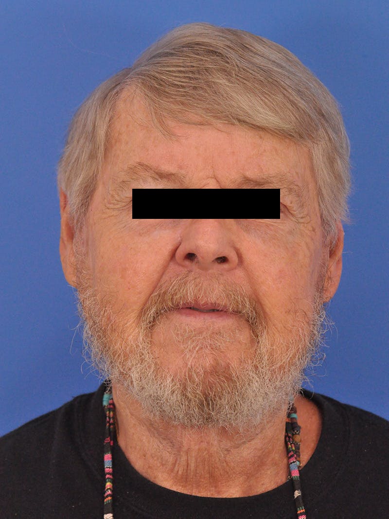 Neck Lift Before & After Gallery - Patient 891184 - Image 6