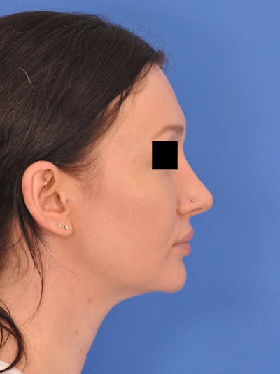 Rhinoplasty Before & After Gallery - Patient 368634 - Image 2