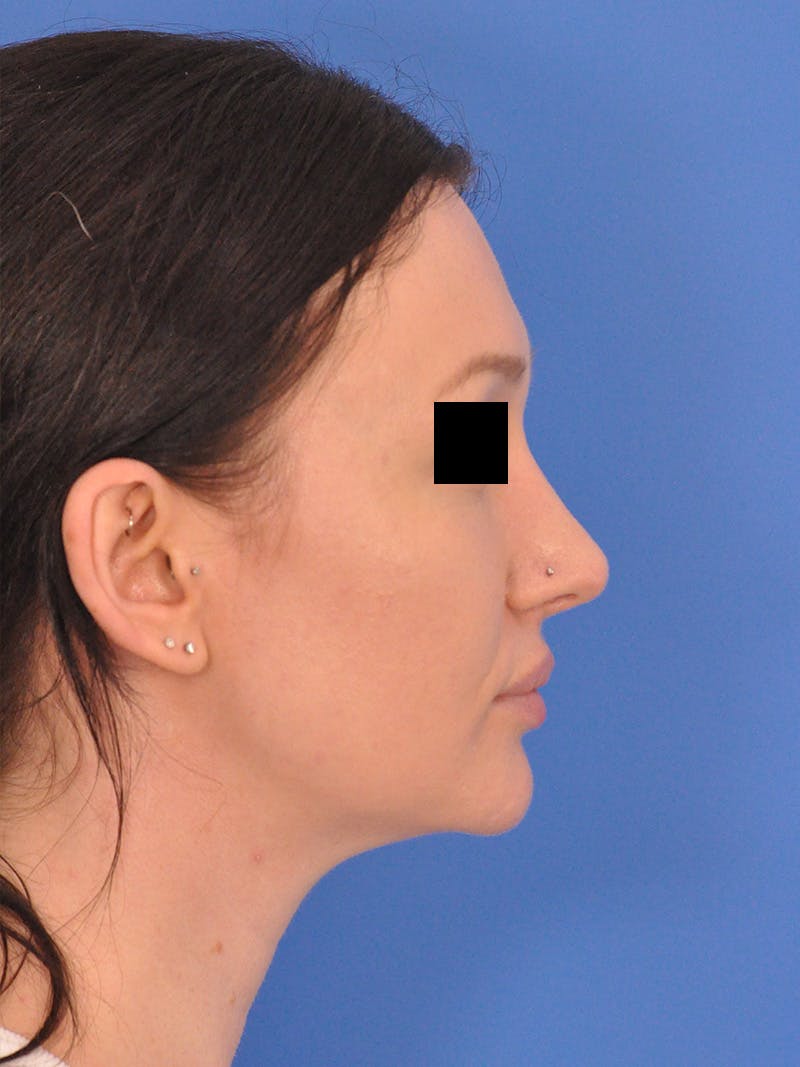 Rhinoplasty Before & After Gallery - Patient 368634 - Image 2