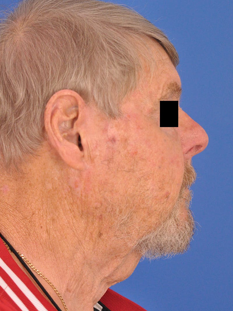 Neck Lift Before & After Gallery - Patient 891184 - Image 1