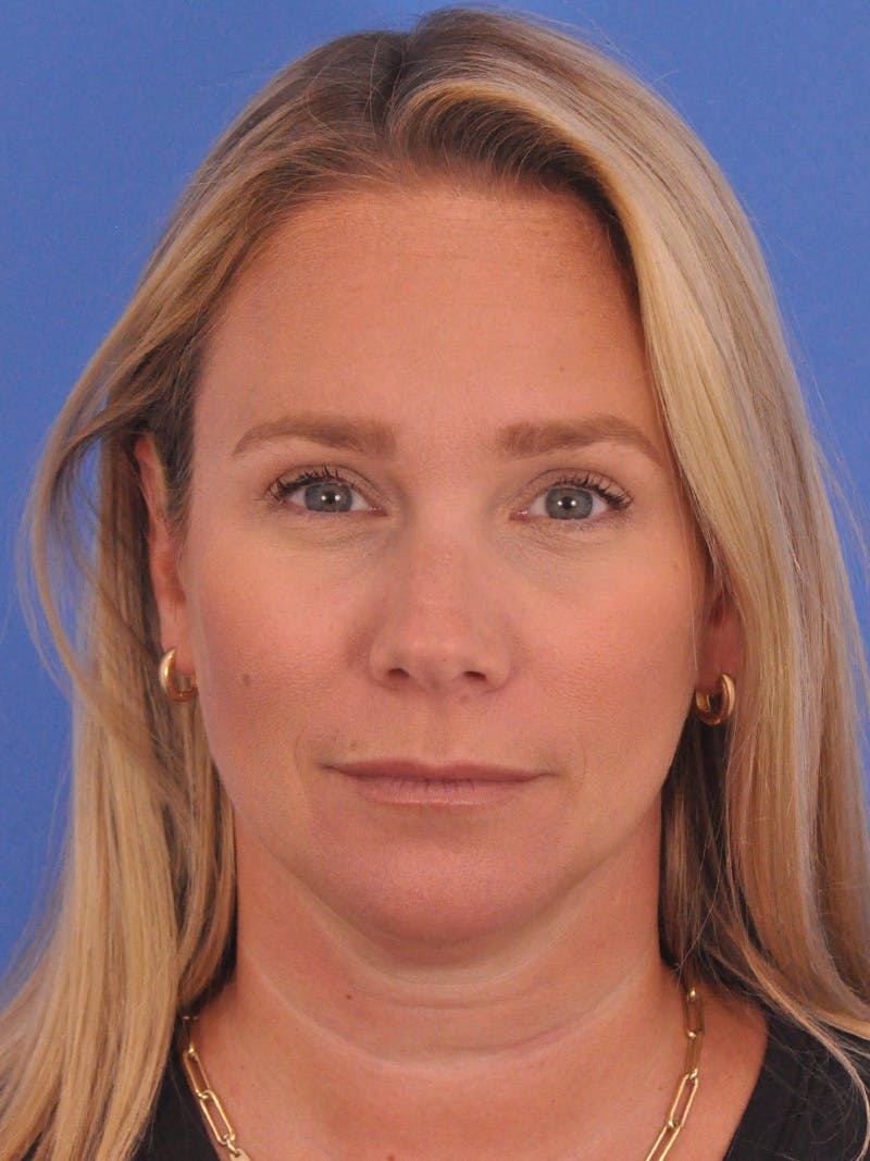 BOTOX Before & After Gallery - Patient 749775 - Image 4