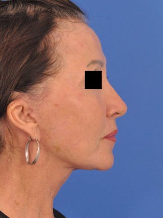 Neck Lift Before & After Gallery - Patient 128768 - Image 2