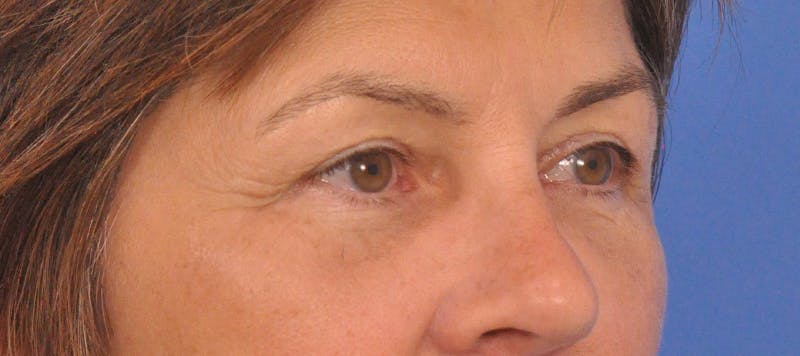 Blepharoplasty Before & After Gallery - Patient 358961 - Image 6