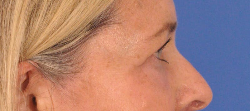 CO2RE Laser Before & After Gallery - Patient 140276 - Image 7