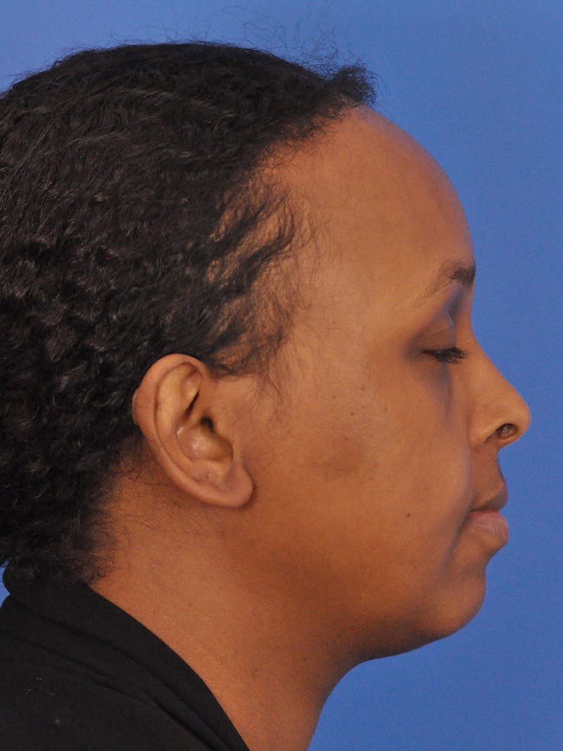 Forehead Reduction Before & After Gallery - Patient 196323 - Image 8