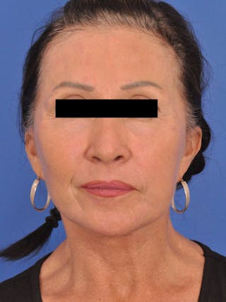 Neck Lift Before & After Gallery - Patient 128768 - Image 6