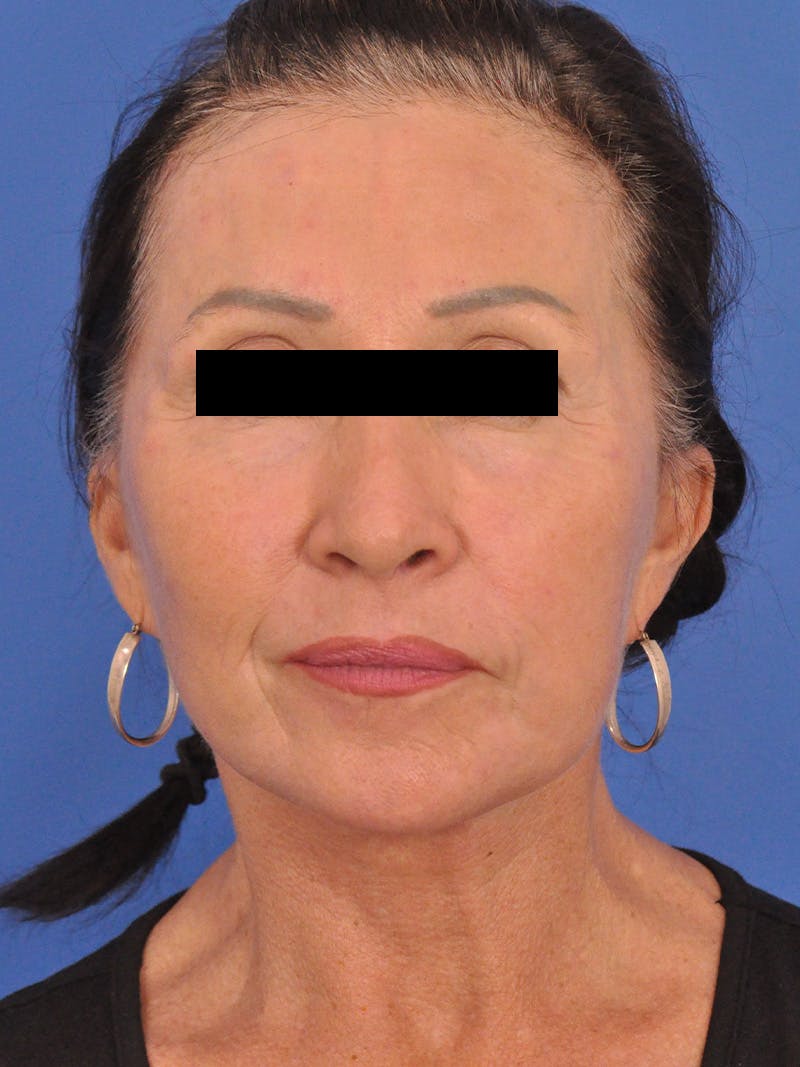 Neck Lift Before & After Gallery - Patient 128768 - Image 6