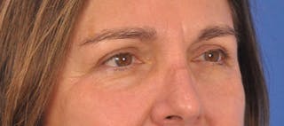 Blepharoplasty Before & After Gallery - Patient 761684 - Image 4