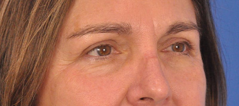 Blepharoplasty Before & After Gallery - Patient 761684 - Image 4