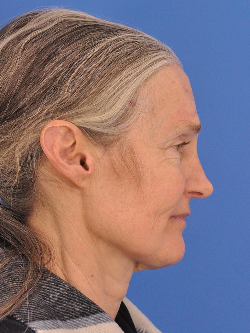 Vbeam Laser Before & After Gallery - Patient 348841 - Image 5