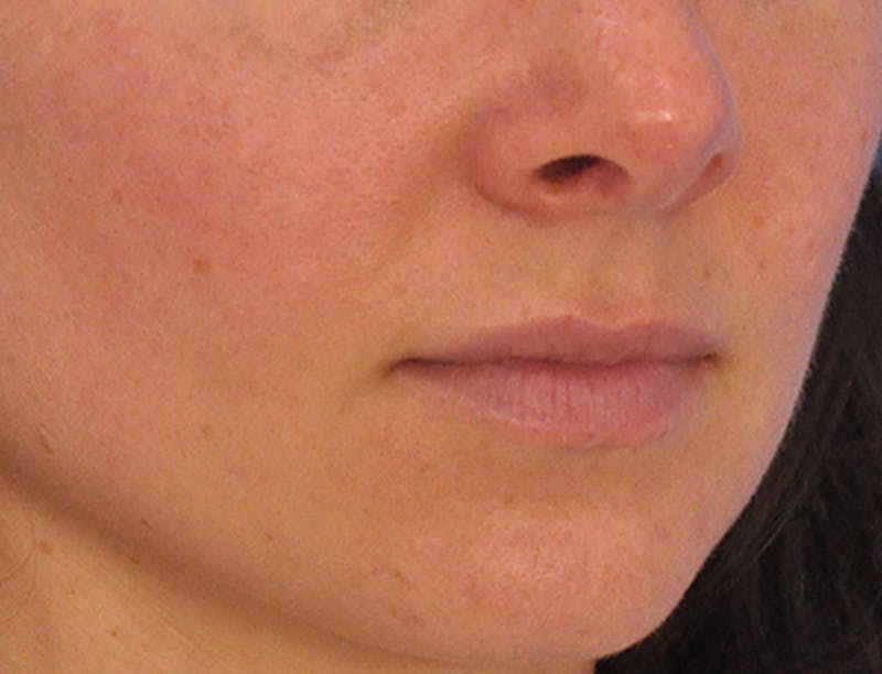 Lip Filler Before & After Gallery - Patient 829353 - Image 5