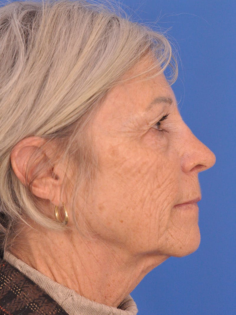 Neck Lift Before & After Gallery - Patient 181998 - Image 1