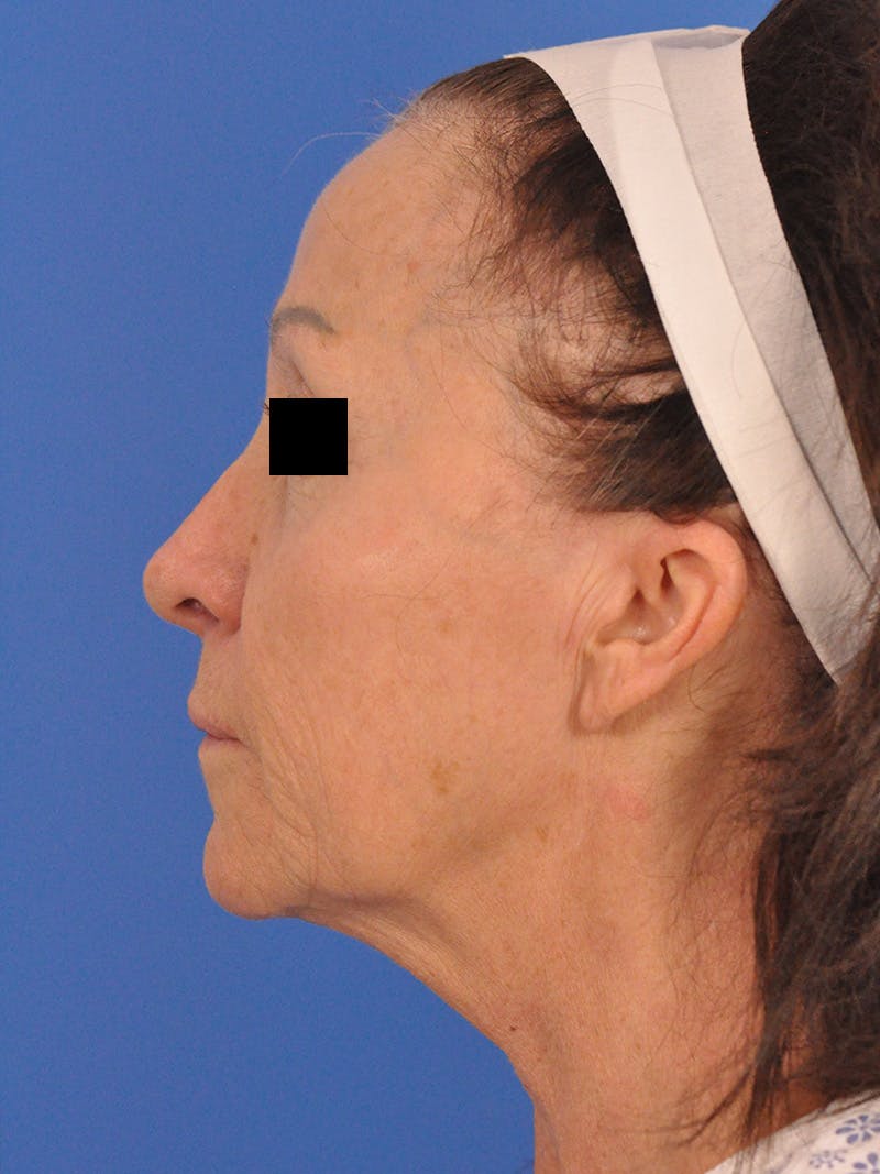 Neck Lift Before & After Gallery - Patient 128768 - Image 9