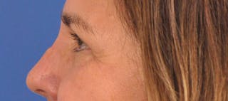 Blepharoplasty Before & After Gallery - Patient 761684 - Image 10