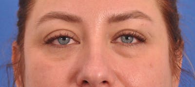 Blepharoplasty Before & After Gallery - Patient 391503 - Image 2