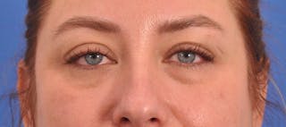Blepharoplasty Before & After Gallery - Patient 391503 - Image 2