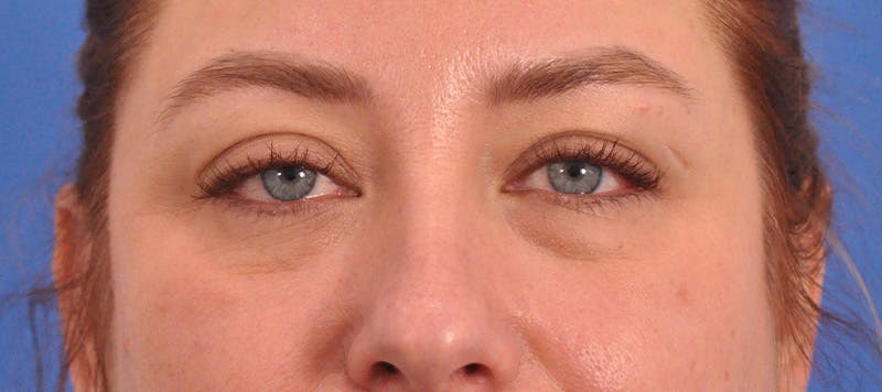 Blepharoplasty Before & After Gallery - Patient 391503 - Image 2